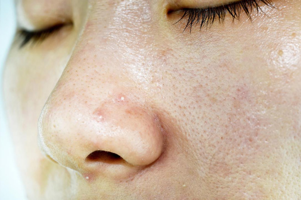 Các bước chăm sóc da mặt dầu không khó, chỉ cần vệ sinh da mặt thật sạch