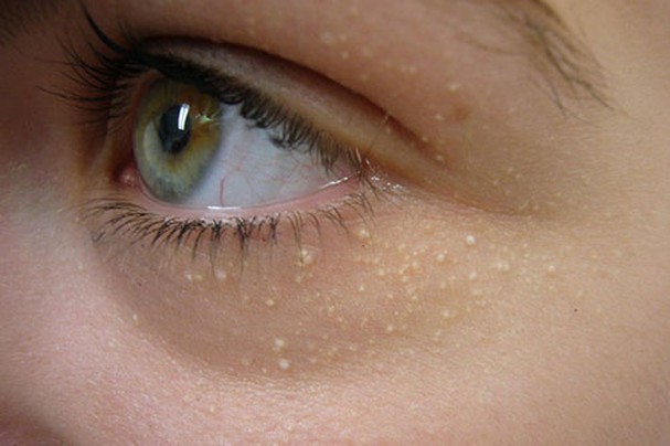 Cách trị mụn đá ở mắt triệt để loại bỏ tế bào hình thành mụn