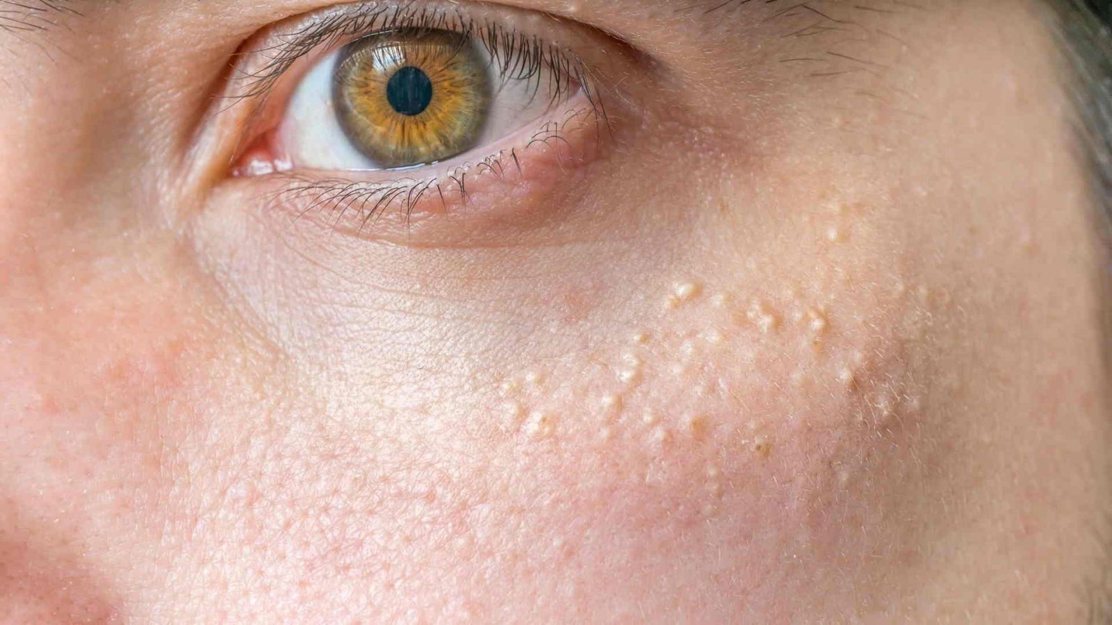 Chăm sóc da sau khi vừa đốt mụn thịt quanh mắt là cần thiết và đem lại hiệu quả cao