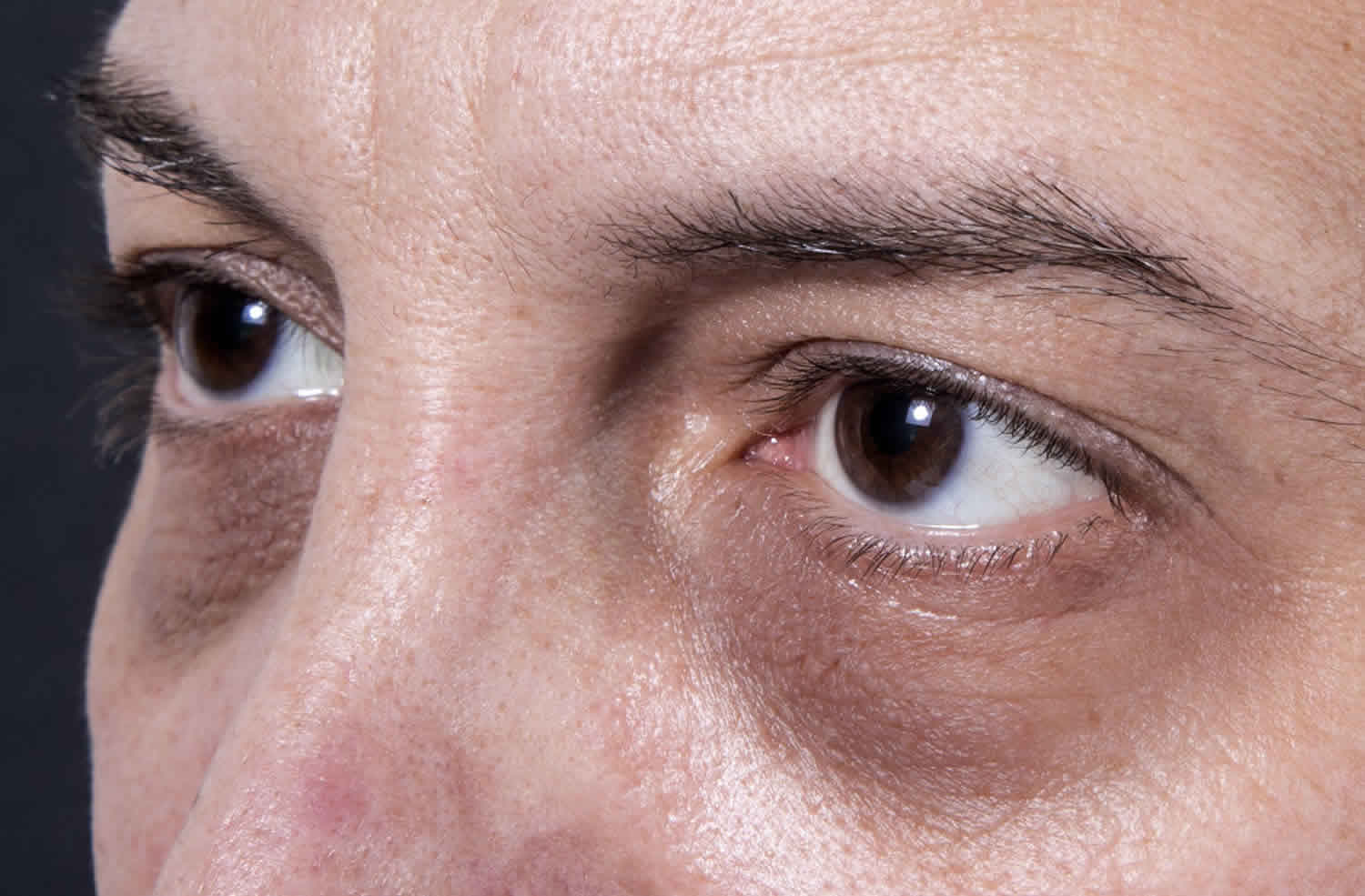 Lão hóa tự nhiên là một nguyên nhân phổ biến khác gây ra những quầng thâm bên dưới mắt của bạn