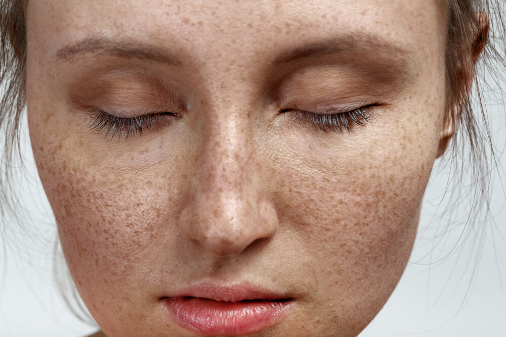 cách chăm sóc da mặt bị nám