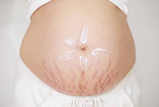 rạn da khi mang thai rất dễ xảy ra