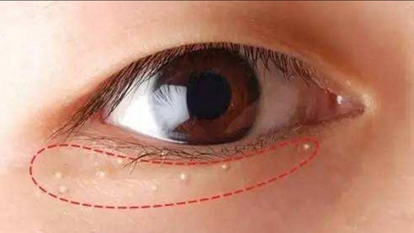 Tránh nặn mụn gần mắt và chăm sóc tốt vùng da quanh mắt