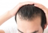 Mẹo giúp mọc tóc nhanh cho nam an toàn hiệu quả