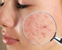 Mụn sưng đỏ không nhân là gì? Phương pháp điều trị hợp lý để nhanh chóng phục hồi làn da